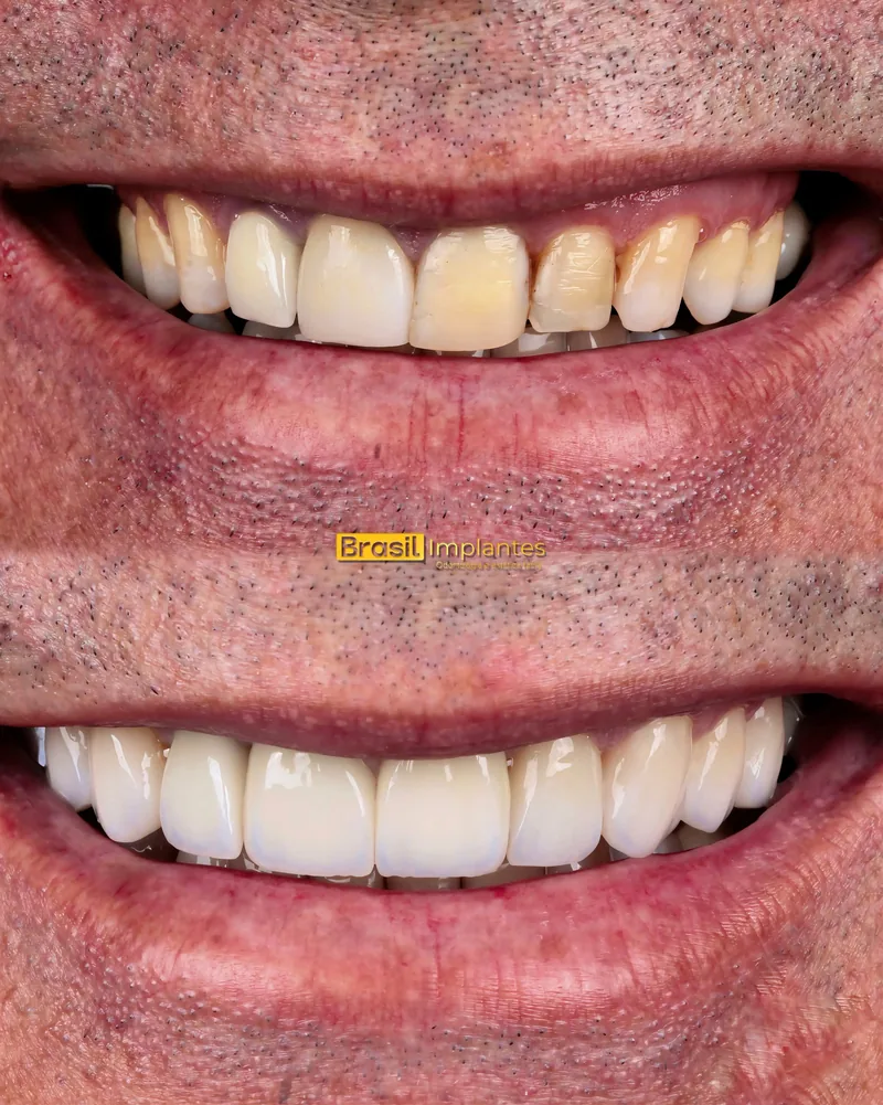 Caso clínico da Brasil Implantes: antes e depois