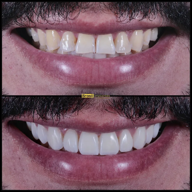 Caso clínico da Brasil Implantes: antes e depois
