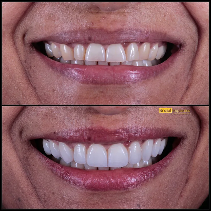 Caso clínico da Brasil Implantes: antes e depois
