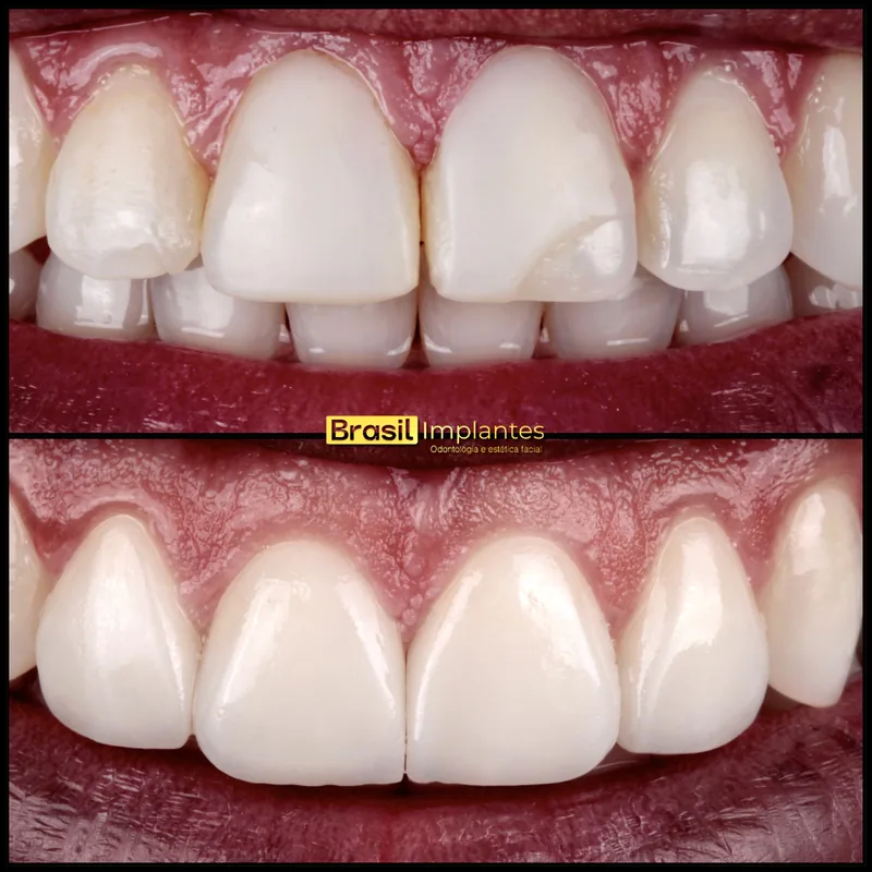 Caso clínico: antes e depois, close dos dentes