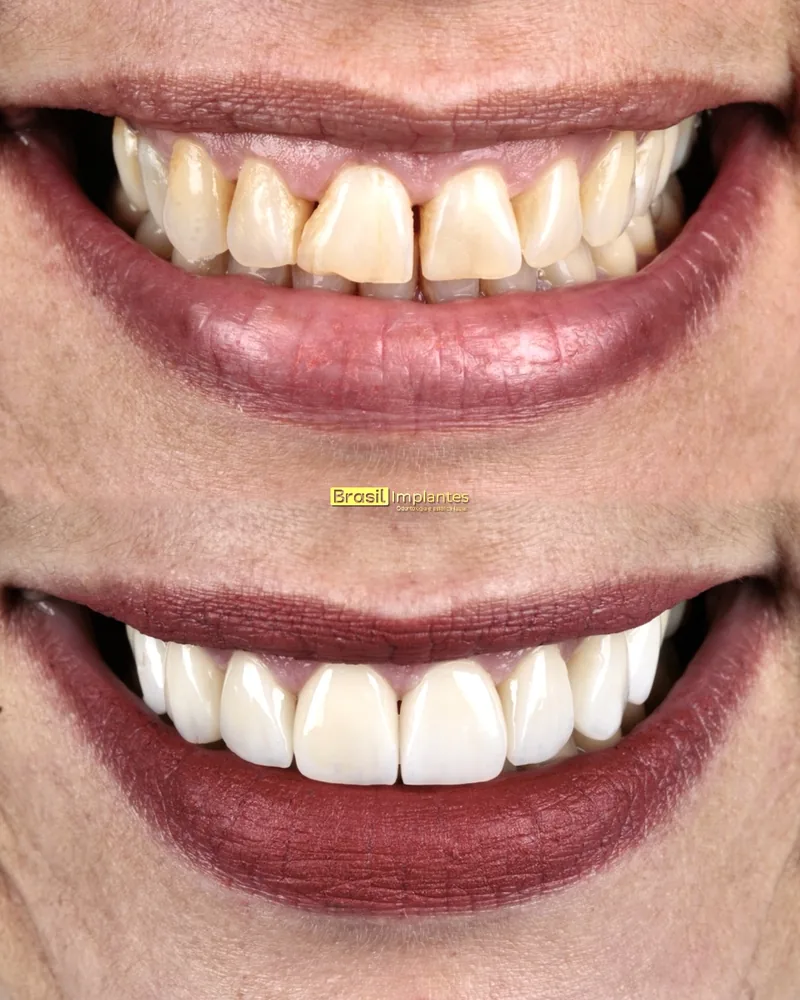 Caso clínico da Brasil Implantes: antes e depois