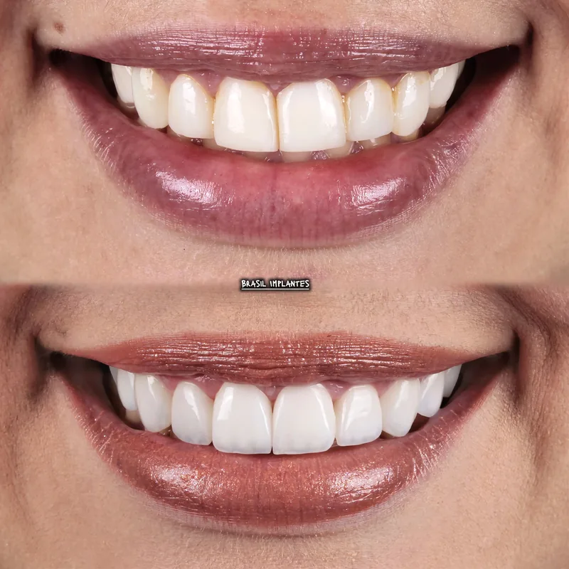 Caso clínico da Brasil Implantes: antes e depois