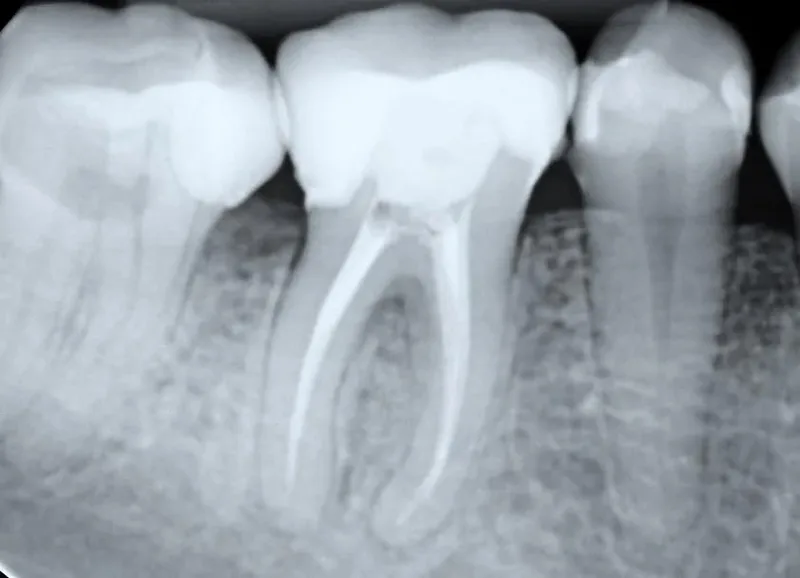 Endodontia na Brasil Implantes